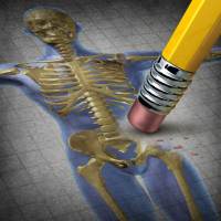 erasing osteoporosis