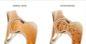 normal bone vs osteoporosis bone